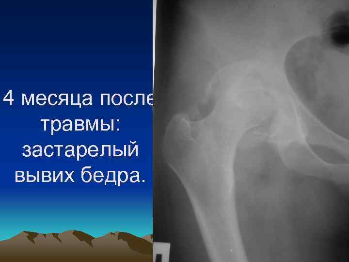 4 месяца после травмы: застарелый вывих бедра. 