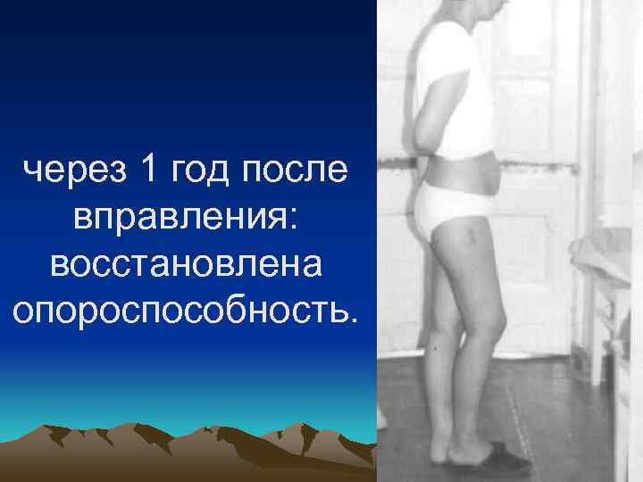 через 1 год после вправления: восстановлена опороспособность. 