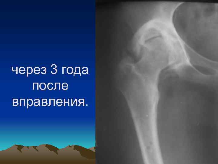 через 3 года после вправления. 