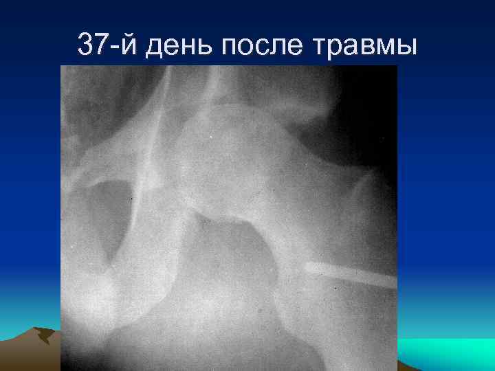37 -й день после травмы 