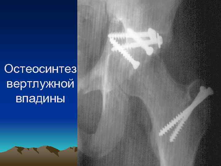 Остеосинтез вертлужной впадины 