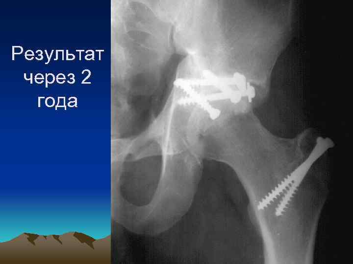 Результат через 2 года 