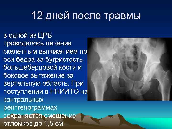 12 дней после травмы в одной из ЦРБ проводилось лечение скелетным вытяжением по оси