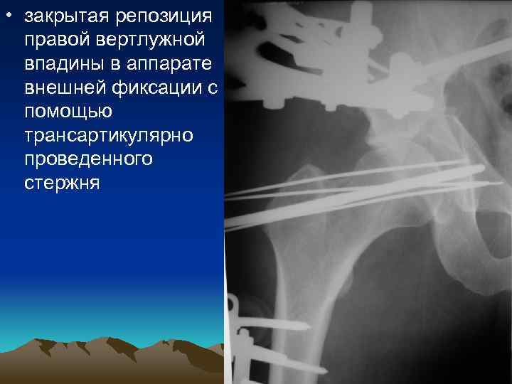  • закрытая репозиция правой вертлужной впадины в аппарате внешней фиксации с помощью трансартикулярно