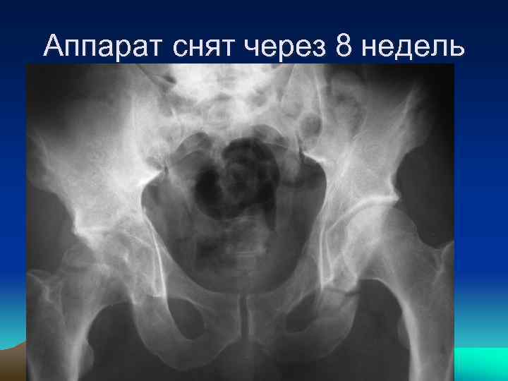 Аппарат снят через 8 недель 