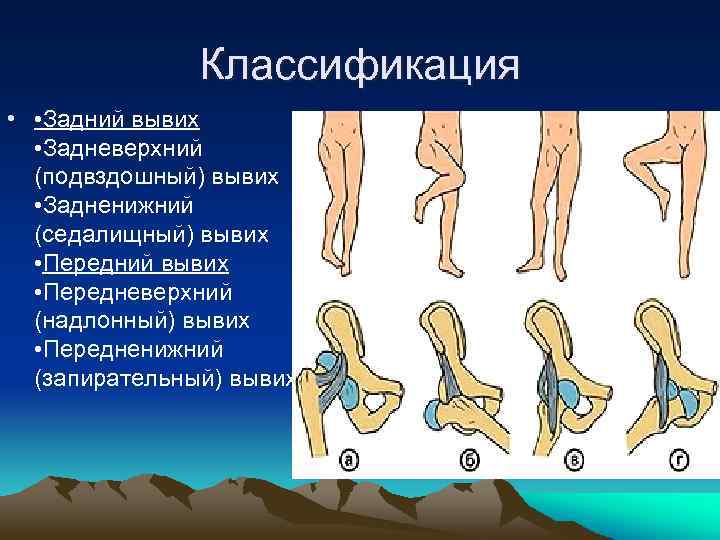 Вывих надколенника карта вызова