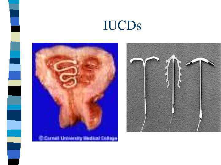 IUCDs 