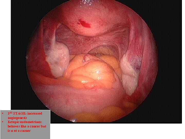  • • 1 ST STAGE: increased angiogenesis Ectopic endometrium: behaves like a cancer