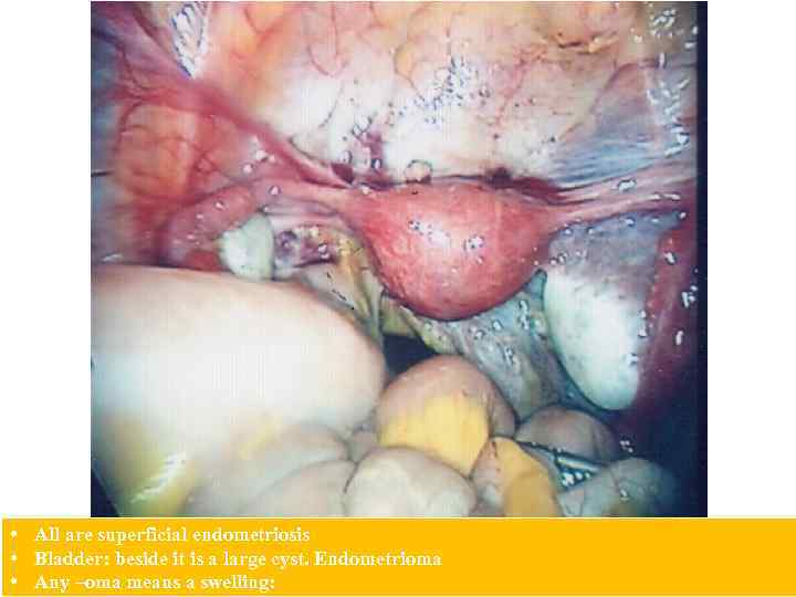  • All are superficial endometriosis • Bladder: beside it is a large cyst.