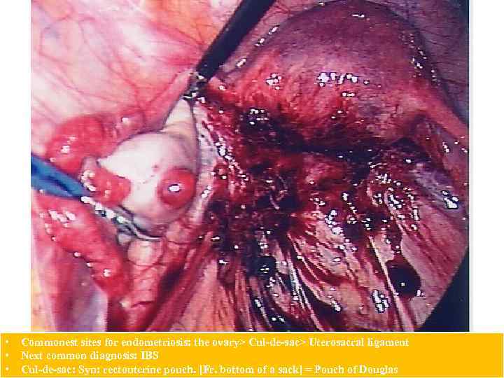  • • • Commonest sites for endometriosis: the ovary> Cul-de-sac> Uterosacral ligament Next