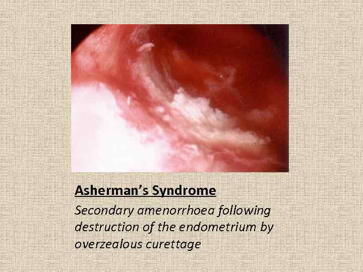 Asherman’s Syndrome Secondary amenorrhoea following destruction of the endometrium by overzealous curettage 