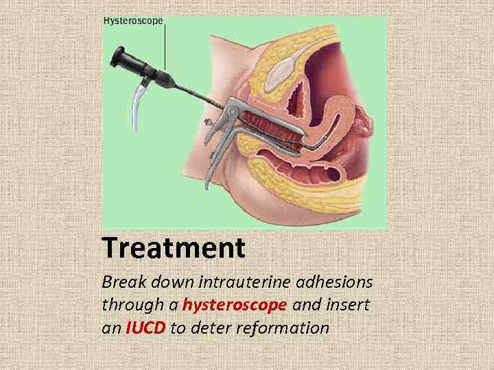 Treatment Break down intrauterine adhesions through a hysteroscope and insert an IUCD to deter