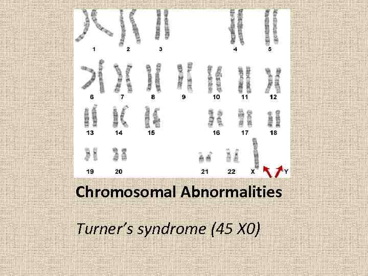 Chromosomal Abnormalities Turner’s syndrome (45 X 0) 