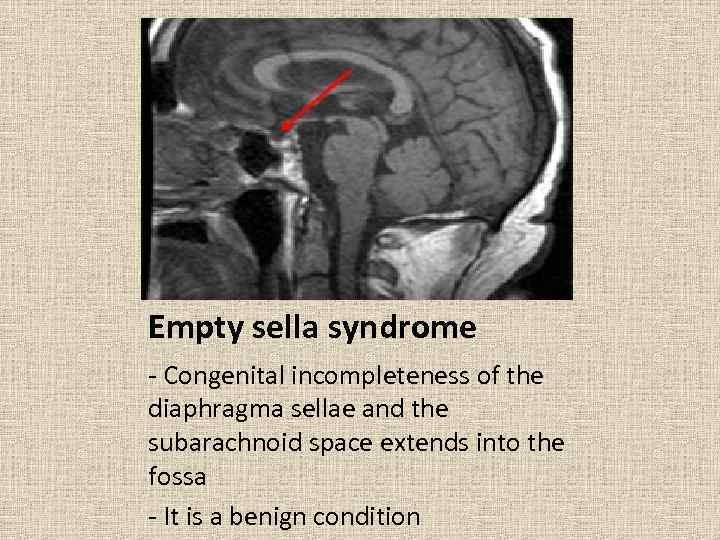 Empty sella syndrome - Congenital incompleteness of the diaphragma sellae and the subarachnoid space