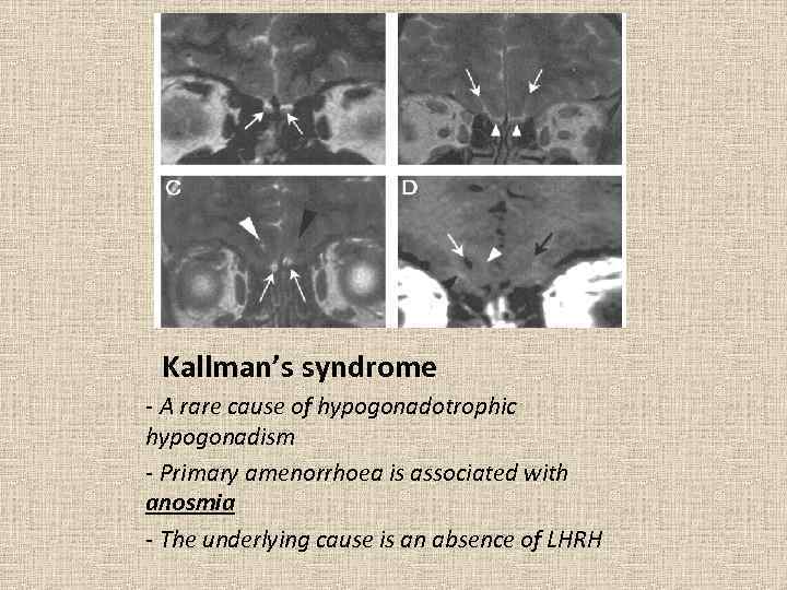 Kallman’s syndrome - A rare cause of hypogonadotrophic hypogonadism - Primary amenorrhoea is associated