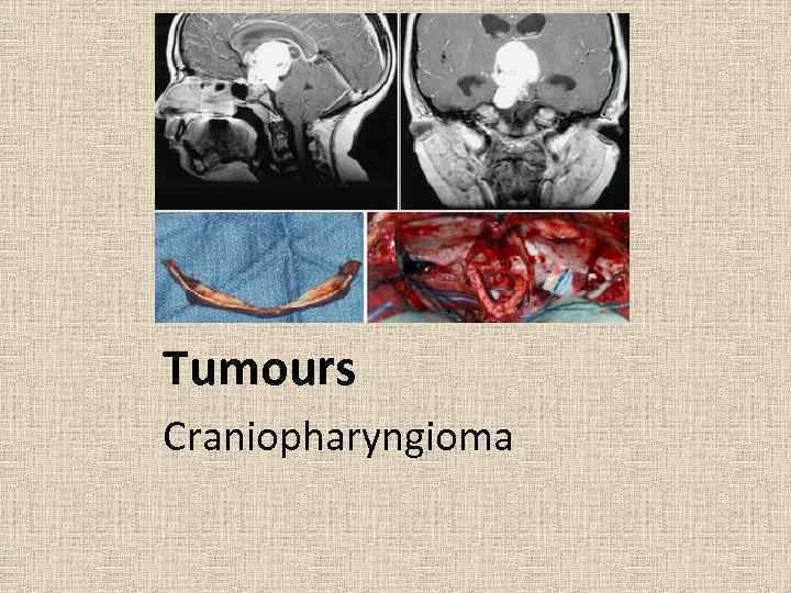 Tumours Craniopharyngioma 