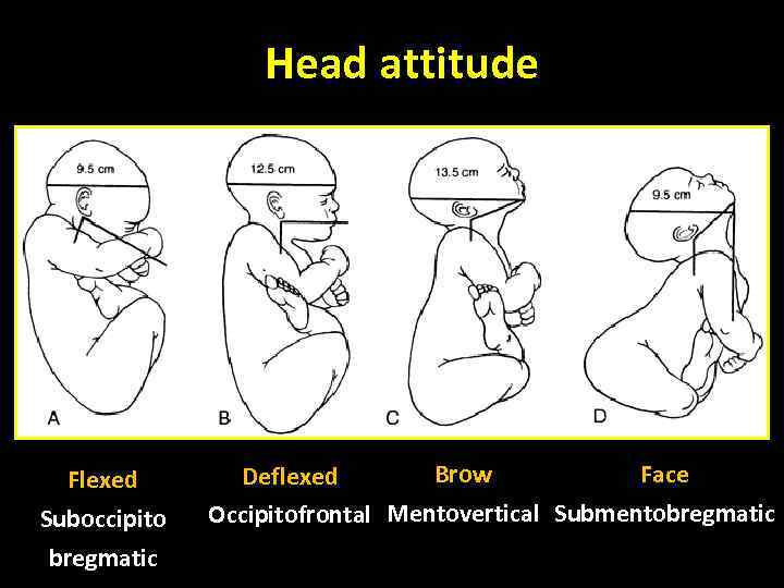 Head attitude Flexed Suboccipito bregmatic Brow Face Deflexed Occipitofrontal Mentovertical Submentobregmatic 