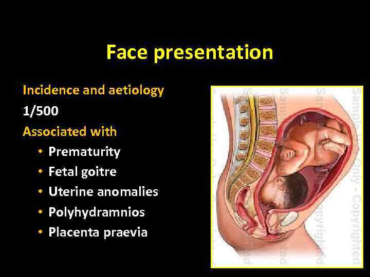 Face presentation Incidence and aetiology 1/500 Associated with • Prematurity • Fetal goitre •