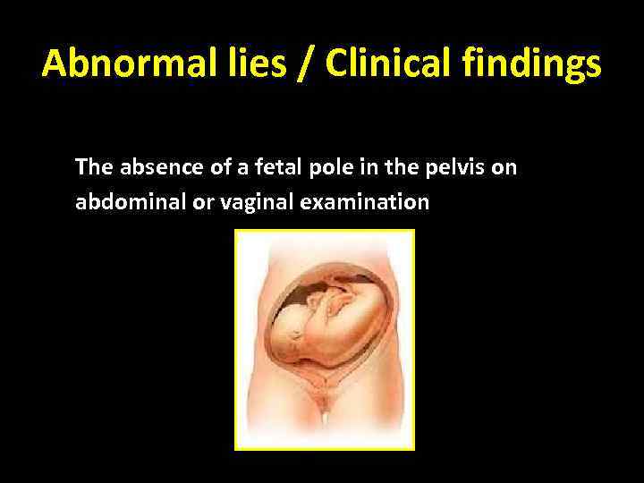 Abnormal lies / Clinical findings The absence of a fetal pole in the pelvis