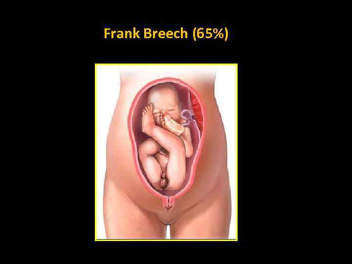 Frank Breech (65%) 