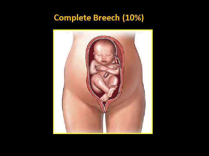 Complete Breech (10%) 