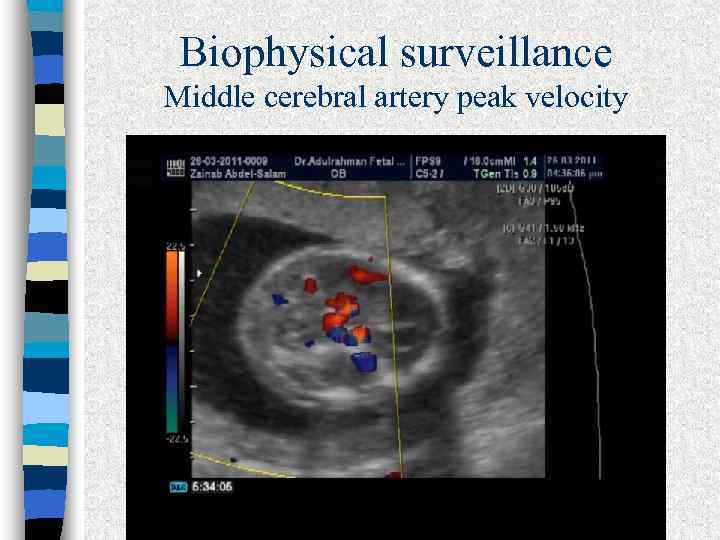 Biophysical surveillance Middle cerebral artery peak velocity 