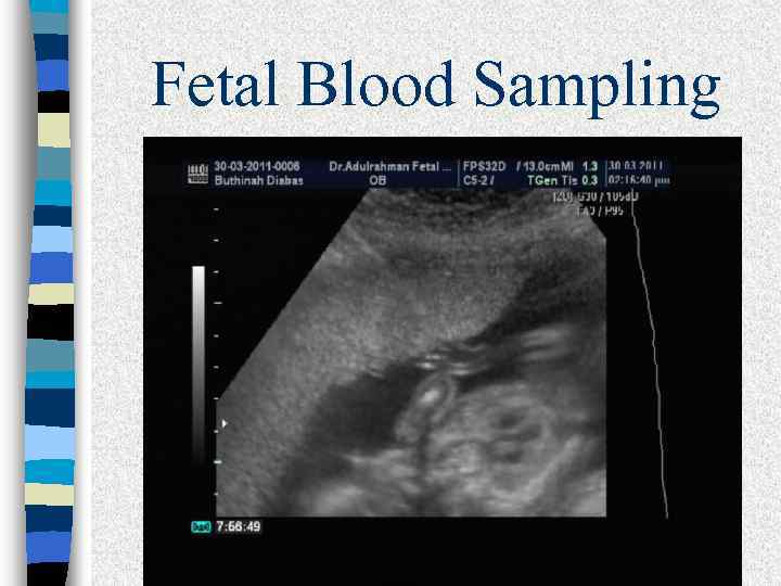 Fetal Blood Sampling 