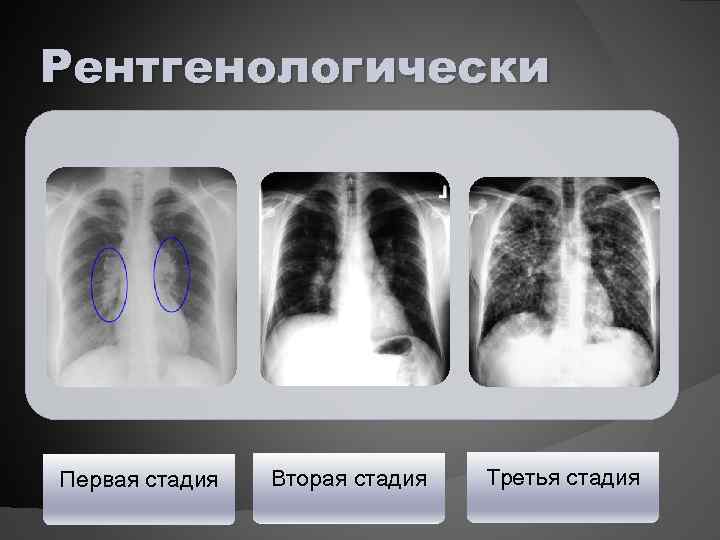 Рентгенологически Первая стадия Вторая стадия Третья стадия 