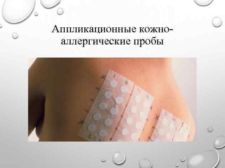 Аппликационные кожноаллергические пробы 