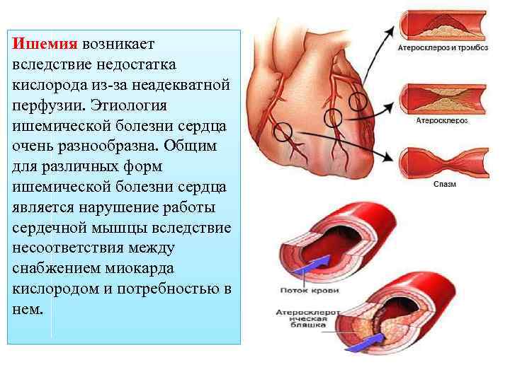 Ишемия возникает вследствие недостатка кислорода из-за неадекватной перфузии. Этиология ишемической болезни сердца очень разнообразна.