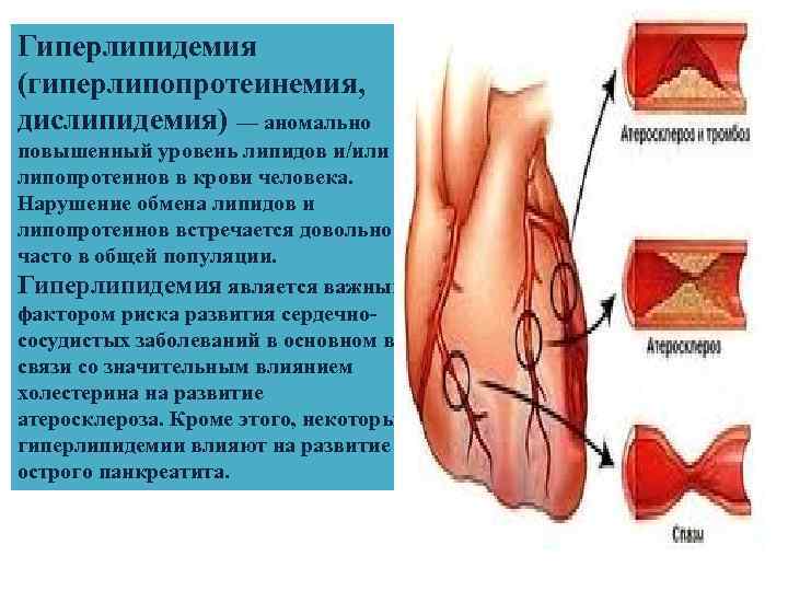 Гиперлипидемия (гиперлипопротеинемия, дислипидемия) — аномально повышенный уровень липидов и/или липопротеинов в крови человека. Нарушение