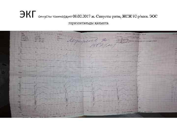 ЭКГ синусты тахикардия 08. 02. 2017 ж. Синусты ритм, ЖСЖ 92 р/мин. ЭОС горизонтальды