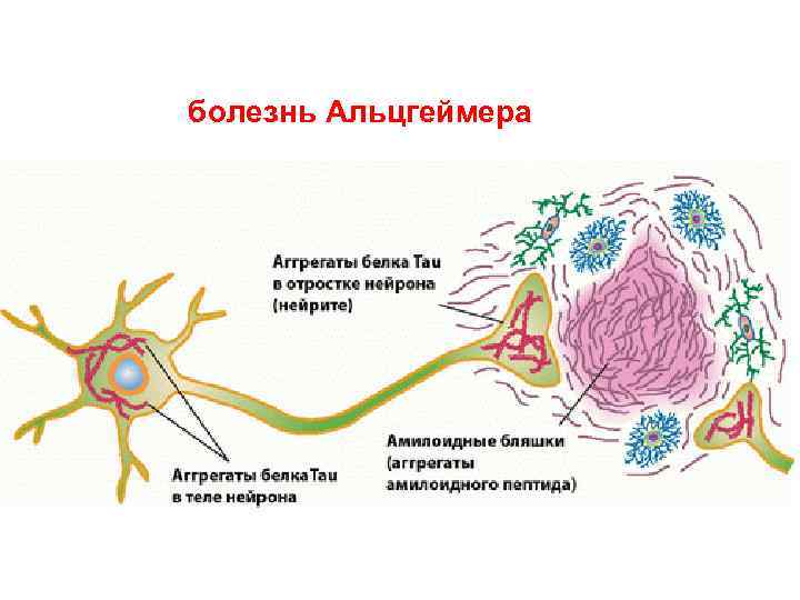 болезнь Альцгеймера 