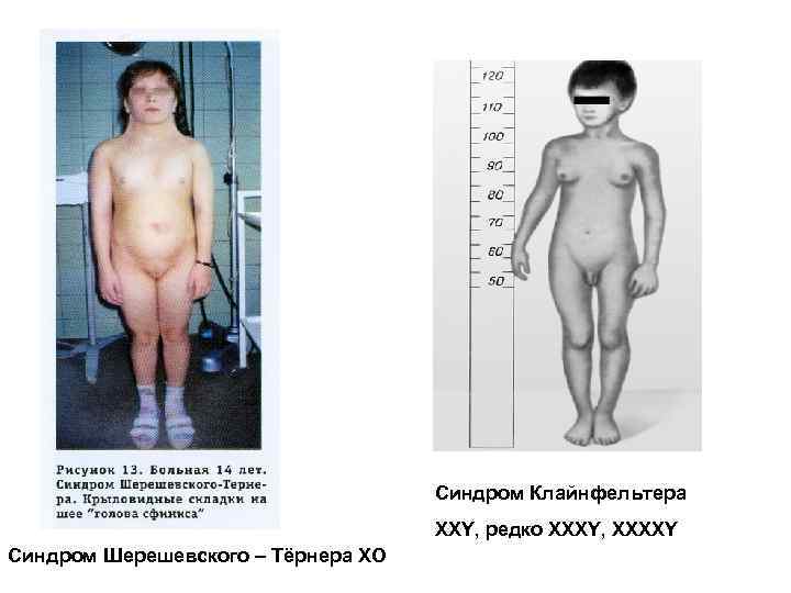 Синдром Клайнфельтера XXY, редко XXXY, XXXXY Синдром Шерешевского – Тёрнера ХО 