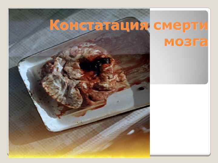 Констатация смерти мозга 