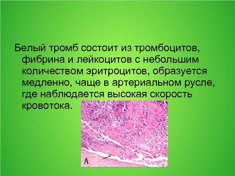 Белый тромб состоит из тромбоцитов, фибрина и лейкоцитов с небольшим количеством эритроцитов, образуется медленно,