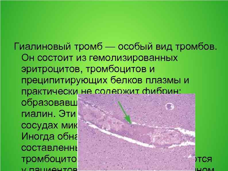 Гиалиновый тромб — особый вид тромбов. Он состоит из гемолизированных эритроцитов, тромбоцитов и преципитирующих