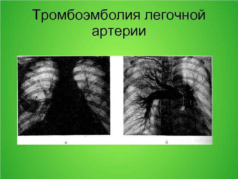 Тромбоэмболия легочной артерии 