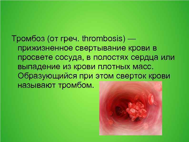 Тромбоз (от греч. thrombosis) — прижизненное свертывание крови в просвете сосуда, в полостях сердца