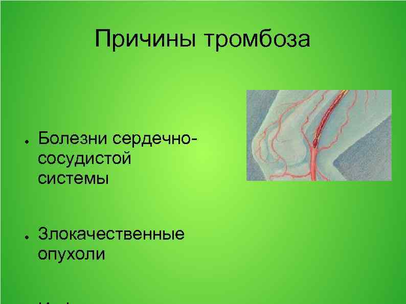 Причины тромбоза ● ● Болезни сердечнососудистой системы Злокачественные опухоли 