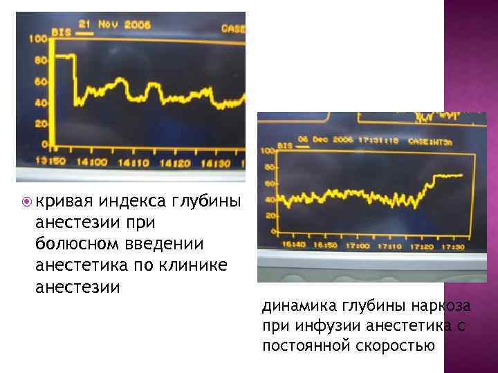  кривая индекса глубины анестезии при болюсном введении анестетика по клинике анестезии динамика глубины