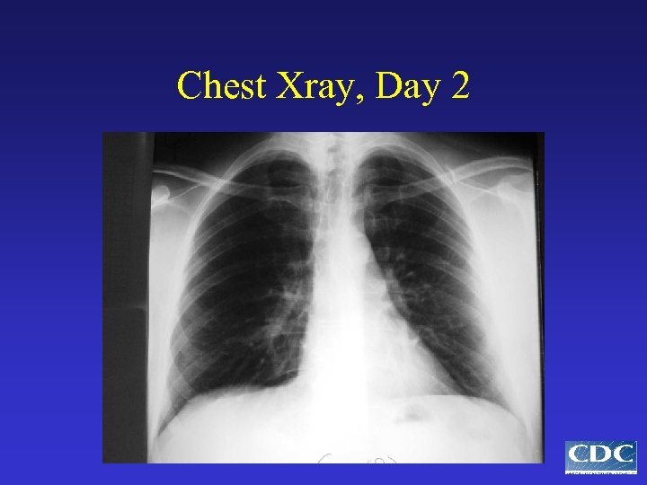 Chest Xray, Day 2 