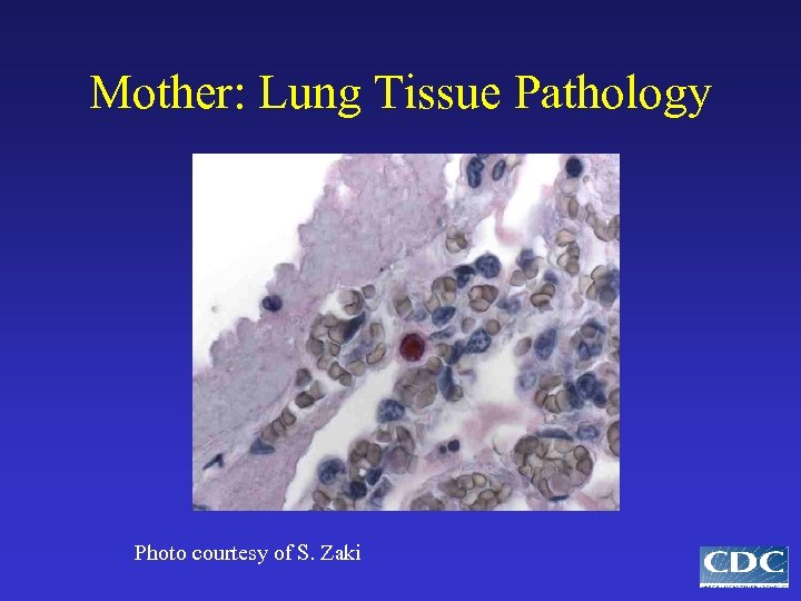 Mother: Lung Tissue Pathology Photo courtesy of S. Zaki 