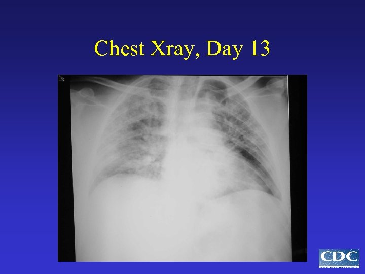 Chest Xray, Day 13 