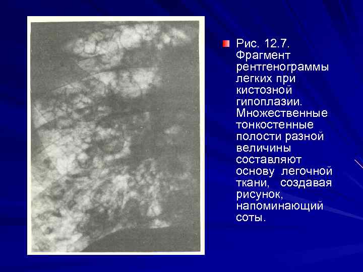 7 фрагмент. Множественные тонкостенные полости. Рентген множественные тонкостенные полости.. Множественные тонкостенные полости в легких. Тонкостенная полость в легком.