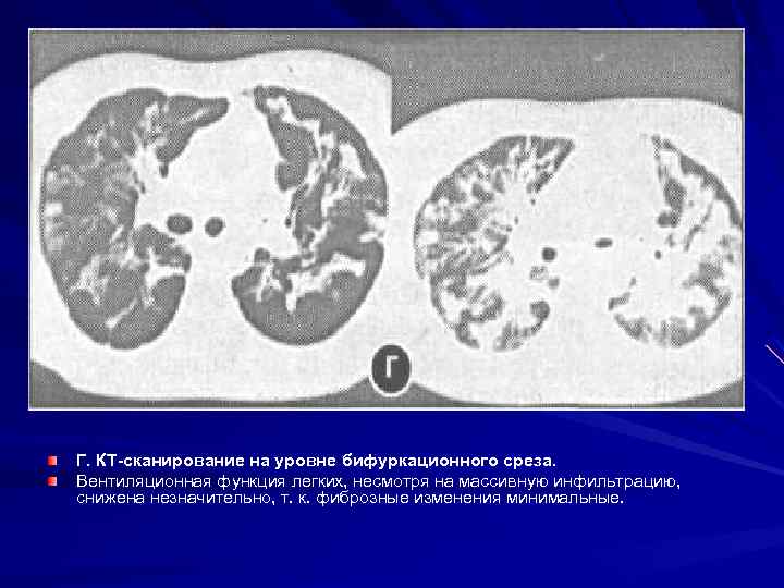 Г. КТ сканирование на уровне бифуркационного среза. Вентиляционная функция легких, несмотря на массивную инфильтрацию,