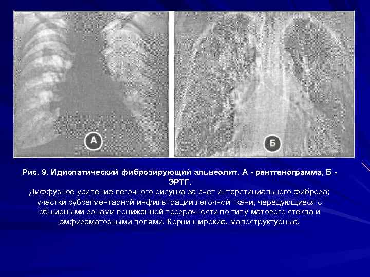 Что такое интерстициальный компонент легочного рисунка