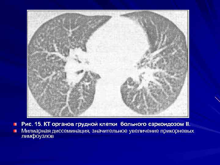 Рис. 15. КТ органов грудной клетки больного саркоидозом II. Милиарная диссеминация, значительное увеличение прикорневых