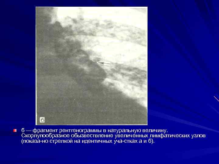 б — фрагмент рентгенограммы в натуральную величину. Скорлупообразное обызвествление увеличенных лимфатических узлов (показа но