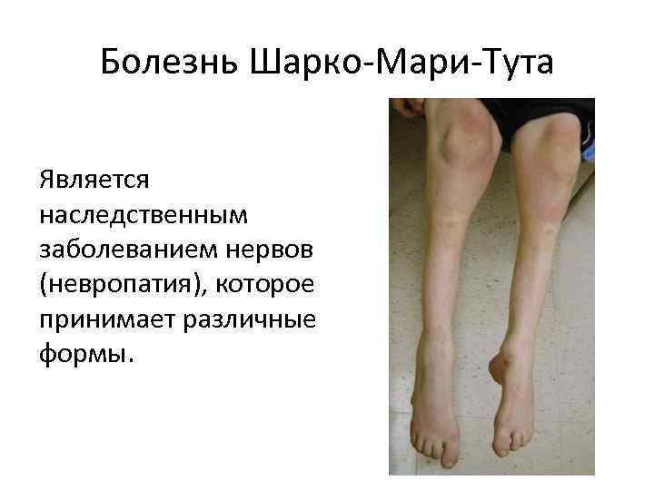 Болезнь Шарко-Мари-Тута Является наследственным заболеванием нервов (невропатия), которое принимает различные формы. 